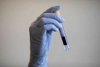 Blood test could revolutionise the way Alzheimer’s is diagnosed