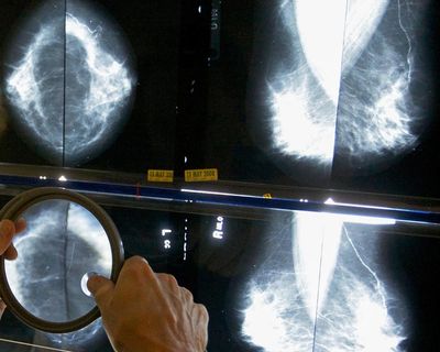 Groundbreaking genomic test could spare millions of breast cancer patients chemotherapy