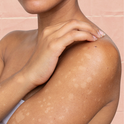 Hyperpigmentation Gets All the Attention. What About Hypopigmentation?