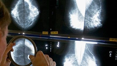 Spain detects 111 cases of rare cancer linked to breast implants