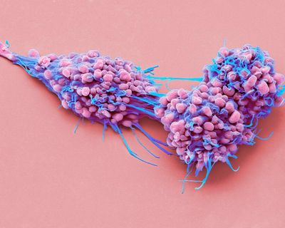 Life-prolonging drug for advanced ovarian cancer gets go-ahead in England