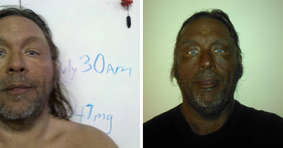 “Breaking New Ground”: Man Reveals Results After Injecting Himself With Unregulated Tanning Peptide Melanotan 2