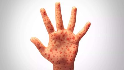 World's most contagious disease detected in California wastewater: Key signs of virus and symptoms you should watch
