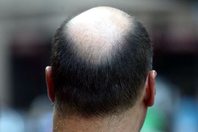 The ancient Chinese herb that transforms hair loss: ‘Studies now confirm this isn’t folklore’