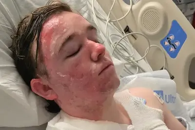 McDonald’s employee left in ‘excruciating’ pain with second-degree burns all over body after co-worker allegedly threw hot oil on him
