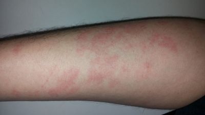 Texas teen is rushed to the hospital after a shower covered in chemical burns, only for doctors to say there is something wrong with the water