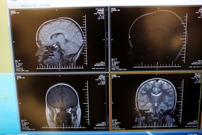 Microplastics Are Accumulating in Human Brains at Alarming Levels — And the Link to Dementia and Heart Disease Is Growing Clearer
