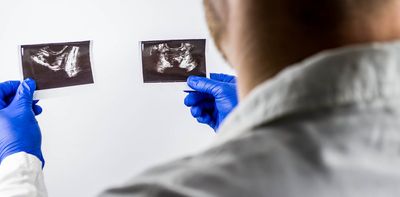 Why some men with prostate cancer may soon need only five radiotherapy sessions