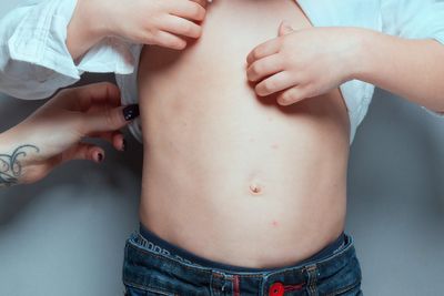 Measles symptoms as two children die following acute outbreak in UK