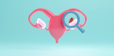 Ovarian cancer drug approved for NHS use will prolong lives