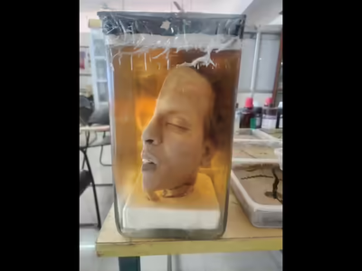 Alavandar Murder Case: Half head that still teaches medical students more than 70 years later