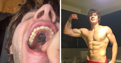 Doctor Warns Of The Risks After “Looksmaxxer” Films Himself Using A Maxilla Expander