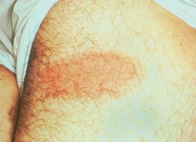 The First Lyme Disease Vaccine in 24 Years Just Passed Its Pivotal Phase 3 Trial with 74 Percent Efficacy — and It Is for Children Too