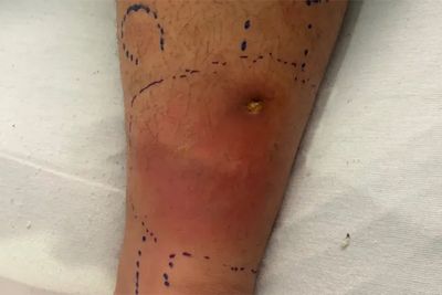 Florida family raises alarm after teen contracts flesh-eating bacteria