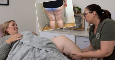 'Not fat and lazy': painful syndrome prevents women from losing weight