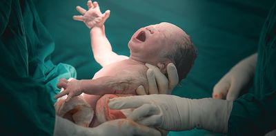 Why more births now end in caesarean section