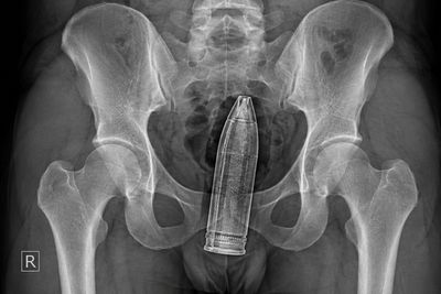 French Hospital Evacuated After Doctors Found World War I Artillery Shell Inside 24-Year-Old Man