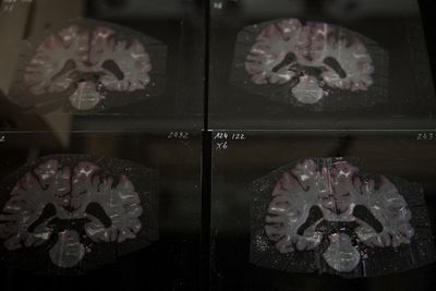 Scientists Just Found That Brain Cells Routinely Shatter Their Own DNA While Building the Brain — And Repair It Within 24 Hours