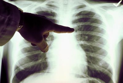 Medscape Report Finds Cytoreductive Surgery During TKI Therapy May Extend Survival in EGFR-Mutated Lung Cancer Patients