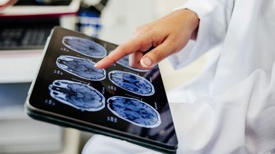 Drug-induced 'brain freeze' may help protect the brain after a stroke, early study suggests