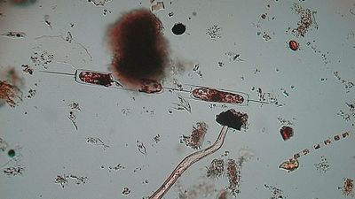 Latest 'flesh-eating bacteria' outbreaks around the world
