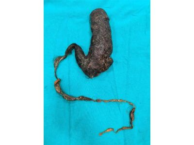 She couldn’t eat properly for months but yet felt full. Faridabad doctors later removed a giant hairball from her stomach