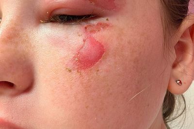 Urgent warning over online ‘squishy’ trend leaving children with skin grafts