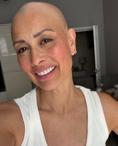 Melanie Sykes proudly shows off bald head amid alopecia battle