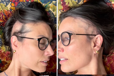 What is alopecia? Experts explain the hair loss condition after Melanie Sykes update