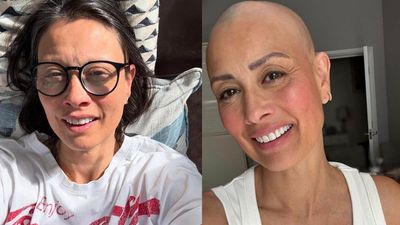 A year after revealing alopecia diagnosis, Melanie Sykes offers candid update on hair loss
