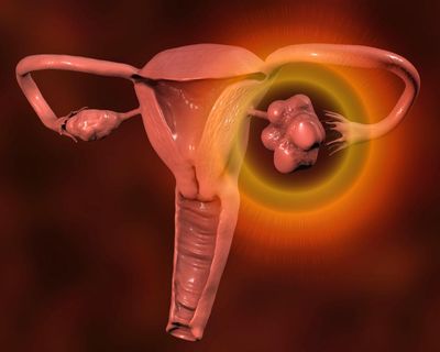 Women with irregular periods should be checked for PMOS, NHS says