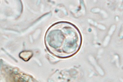 Mystery parasite that causes ‘explosive diarrhea’ spreads to 17 US states
