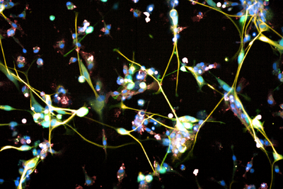 Brain cancer breakthrough as new study finds cell therapy could target deadly glioblastoma