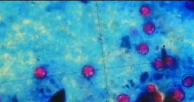 What Is Cyclosporiasis? 145 Sick in 17 States as Outbreak Tests US Food Safety