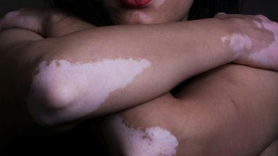 Vitiligo : mieux comprendre cette maladie de la peau