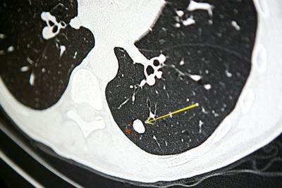 UCLA Found a Hidden Weakness in Some of the Deadliest Cancers, and Existing FDA-Approved Drugs May Already Be Able to Exploit It