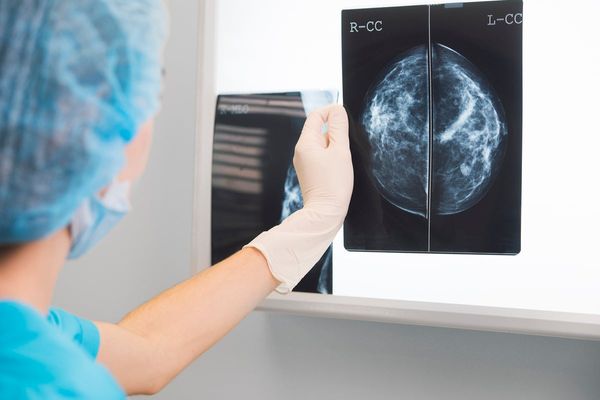 Florida woman was told nothing showed up on her mammogram. Now, she is getting $7M after her stage 4 breast cancer