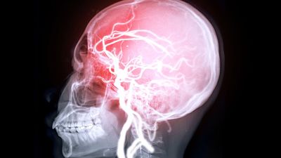 Heart issues tied to 'microdamage' in the brain might raise risk of memory loss, study hints
