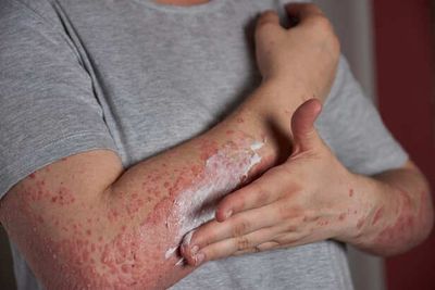 How to Protect Your Skin From Hidden Monsoon Infections