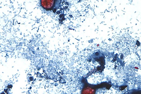 Outbreak of diarrhea-causing parasite grows to more than 1,000 cases