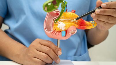 Cancer du Pancréas : pourquoi de nouvelles pistes de traitement suscitent l’espoir