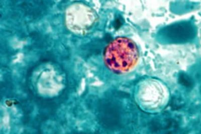 Michigan's Cyclospora Surge Follows a Year of Cuts to US Parasitic Disease Programmes Under Musk and RFK Jr
