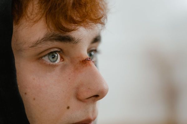 Teen Suffers Broken Nose After Gang of Around 12 Allegedly Attacks Him for Speaking Ukrainian