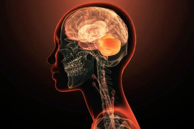 What people with Metabolic Syndrome should know about their brain health