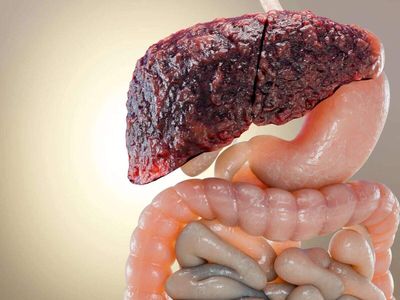 Fatty liver new treatment found: Study discovers a medicine that reverses severe fatty liver by just repairing the gut