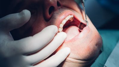 The bacteria behind gum disease may also harm your heart valves, early research suggests