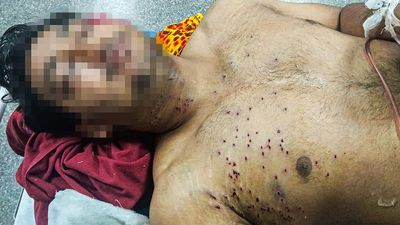 Fourth pellet-like injury after July 20 march: DU student’s family says he may lose an eye