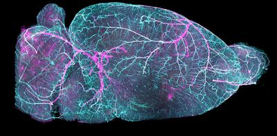 Cerebral small vessel disease: new treatment possibilities for the little-known condition affecting millions of people