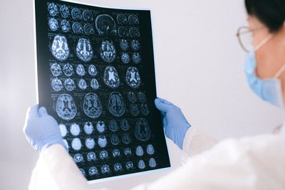 Johns Hopkins Scientists Grew Miniature Brains From Alzheimer's Patients' Cells to Test How Different People Respond to the Same Drug
