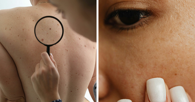 Dermatologist Reveals The Major Red Flag On Your Skin That Could Signal Heart Problems